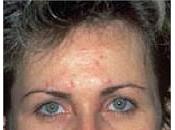 Consejos efectivos contra acné