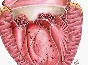 endocarditis