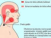 Puntos gatillo