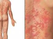 urticaria