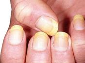 color forma uñas ayudan diagnosticar ciertas enfermedades