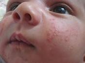 Variedades acné pediatría