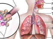 Consejos para tratar fibrosis pulmonar