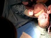 ¿Deberían médicos esperar poco para cortar cordón umbilical?