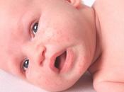 acné bebés