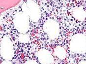 Células entrenadas contra leucemia