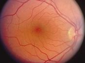 Tratamiento alteraciones retina