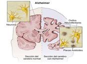 Enfermedad Alzheimer