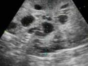 Descubierta mecanismo induce migración células cancerosas