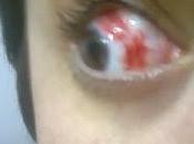 explotó ojo!