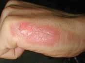 Burnoutizado
