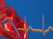 Procoralan(R) reduce riesgo muerte hospitalización pacientes insuficiencia cardiaca