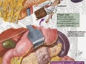 Insulinoma pancreatoctomía