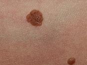 Verrugas mezquinos, virus ataca piel