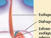 síntomas, remedios tratamiento esofagitis