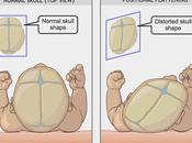 niños plagiocefalia necesitan casco corrector