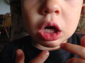 enfermedad mano-pie-boca virus Coxsackie atacan nuevo