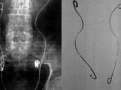 casos catéteres ureterales doble olvidados años problemas