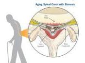 Ensayo aleatorizado inyección glucocorticoides epidural para estenosis espinal