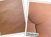 Como Quita Celulitis