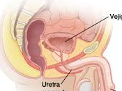 Historia cómo vive paciente operación Uretroplastia