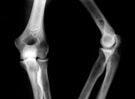 ensayo demuestra ultrasonidos aceleran curación fracturas óseas