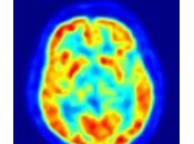 Frecuencia grupos edad específicos población β-amiloidosis cerebral neurodegeneración, personas función cognitiva normal años: estudio transversal.