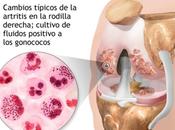 Artritis Gonocócica conoces?