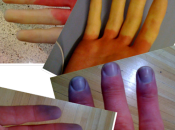 ¿Qué Fenómeno Raynaud?