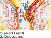 nueva cirugía ambulatoria evita molestias posoperatorio hemorroides