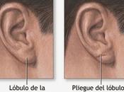 Pliegue diagonal lóbulo oreja enfermedad cardiovascular