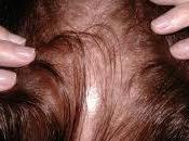 Conoce todo relativo alopecia androgenica mujeres