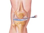 Ácido Hialurónico profilaxis complicaciones artritis