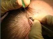 Tipos injerto cabello