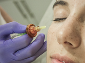 Carboxiterapia para rejuvenecer piel, estrías, acné, celulitis mucho más…