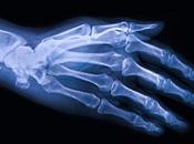 Nuevas “microcápsulas” tienen potencial reparar daños Osteoartritis