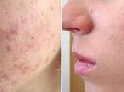 Mascarilla casera para combatir acné