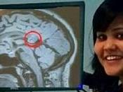 caso mujer tenía "gemelo" convertido tumor cerebral