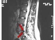 Tratamiento quirurgico Hernia Discal