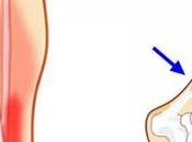 lesiones comunes ciclismo.