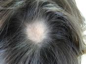 Alopecia areata: causas tratamientos
