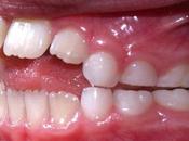 CONSECUENCIAS EXCESIVO BIBERÓN CHUPETE. Deglución atípica