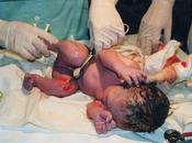 anestesia epidural afecta recién nacidos