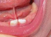 Frenillo lingual corto