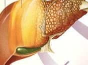 Hígado graso: síntomas cómo evitarlo