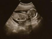 ¿Qué restricción crecimiento intrauterino?