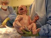 Etapas parto: Alumbramiento