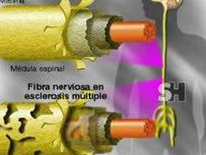 Herpes esclerosis múltiple