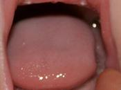 Signos síntomas aparición dientes leche