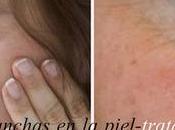 Manchas piel- Causas tratamientos para cuidarla